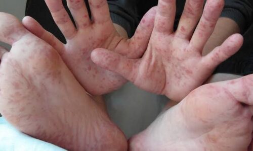 Brote de virus coxsackie en una primaria de Puebla